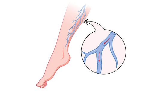 What Are Varicose Veins and how can they be treated? – Dr. Segal's - Canada